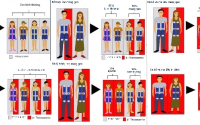 Bệnh Thalassemia - tan máu bẩm sinh: Phòng bệnh hơn chữa bệnh