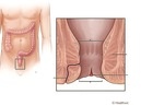 Biến chứng nguy hiểm của bệnh nứt kẽ hậu môn