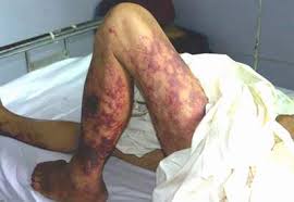 Tử vong sau 3 ngày ăn thịt lợn bệnh: Nghi nhiễm liên cầu lợn