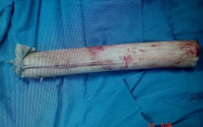 Cứu sống bệnh nhân bị cành cây đâm xuyên lưng, đứt ruột
