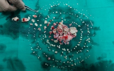 Ấn Độ: Phẫu thuật loại bỏ 232 chiếc răng dư