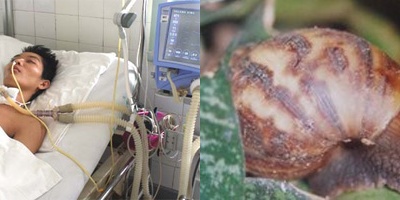 Sự thật về việc ăn ốc sên bị viêm não