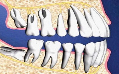Mòn cổ răng chữa thế nào?