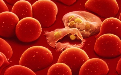 9 triệu chứng của ung thư máu