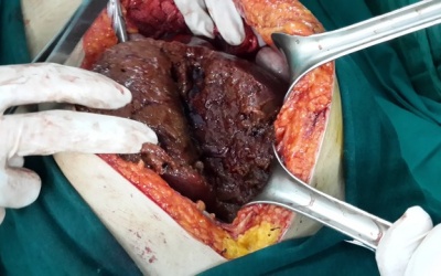 Lào Cai phẫu thuật thành công ca tai nạn đa chấn thương