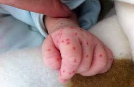 Sốt nổi chấm đỏ có phải là sốt xuất huyết không?