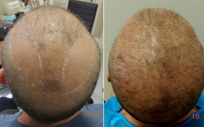 Khỏi hói đầu hoàn toàn nhờ cấy tóc