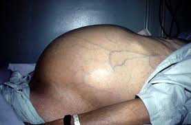 Xơ gan: Diễn tiến âm thầm nhưng nguy hiểm