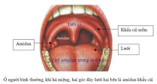 Khi nào nên cắt amiđan?