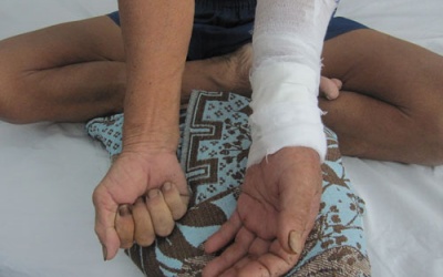 Cẩn thận khi đắp thuốc sau chấn thương