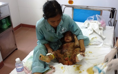 Bình Định: Tiếp nhận bệnh nhi lở loét toàn thân hiếm gặp