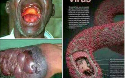 Cảnh báo: Dịch Ebola có nguy cơ lây lan ra toàn thế giới