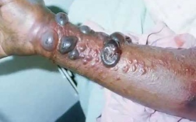 Philippines: 7 trường hợp nghi nhiễm Ebola đầu tiên