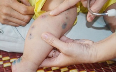 Vĩnh Long: Điều trị thành công tay-chân-miệng