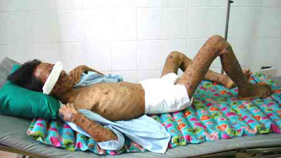 16 tỉnh gia tăng số người nhiễm HIV