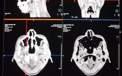 Khánh Hòa: Phẫu thuật thành công túi phình động mạch não
