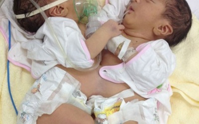 Cặp song sinh dính liền nhau đã được xuất viện