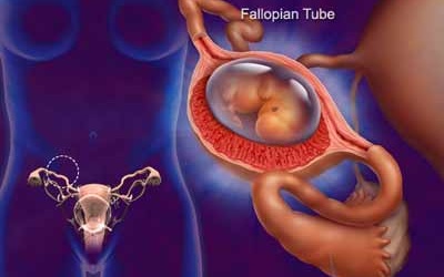 Mang thai ngoài tử cung: Triệu chứng và cách điều trị