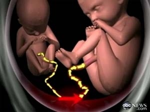 Cặp song sinh sống sót sau hội chứng hiếm gặp