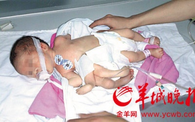 Kỳ lạ bé sơ sinh có 4 chân, 4 tay
