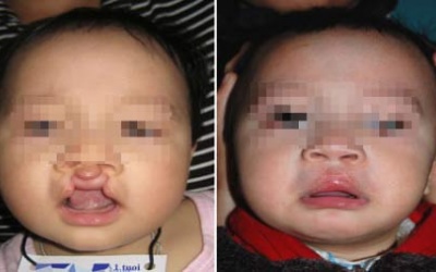 Có sai sót chuyên môn trong vụ 3 trẻ tử vong khi phẫu thuật