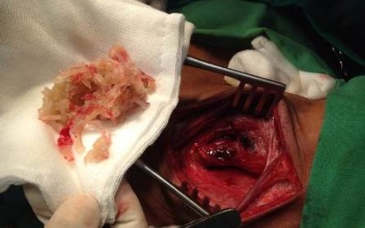 Phẫu thuật gắp nguyên cục nem chua ở vùng họng