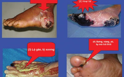 Ngừa cắt cụt chân ở bệnh nhân đái tháo đường