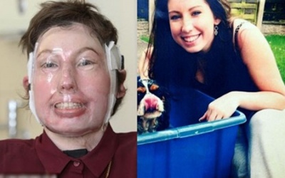 Bỏng 96% cơ thể vẫn sống sót thần kỳ