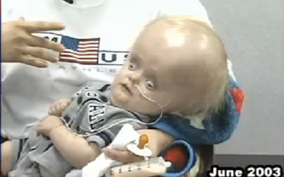 Cậu bé không có bán cầu não qua đời ở tuổi 12