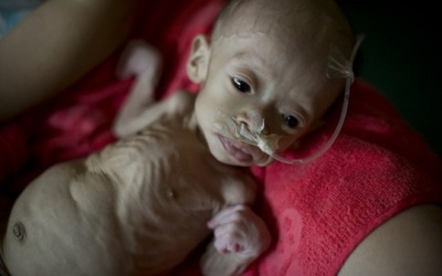 Xót xa bé gái mắc bệnh lạ trông như người ngoài hành tinh