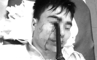 Phẫu thuật thành công cho người bị cán gương đâm xuyên hốc mắt