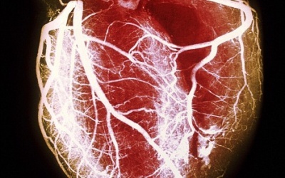 Ca ghép tim chưa từng gặp trên thế giới thành công