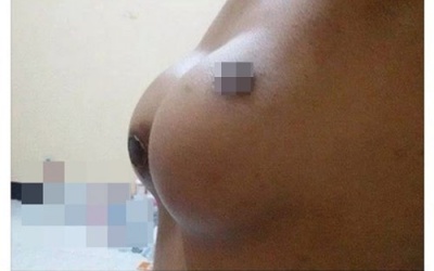 “Cơn ác mộng” sau phẫu thuật nâng ngực