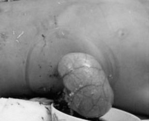 Cứu bé trai người Campuchia bị trâu húc lòi ruột