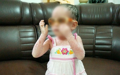 Phát hiện bệnh nhân mắc bệnh vảy cá hiếm gặp