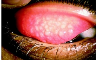 6 khuyến cáo phòng, chống bệnh đau mắt đỏ