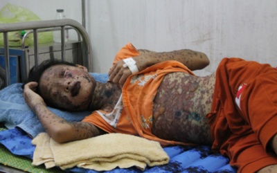 Cứu sống bệnh nhi bị bỏng do dị ứng thuốc