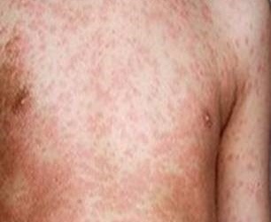 Sởi ở người lớn: Khó phát hiện và dễ có biến chứng