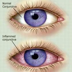 Chưa có thuốc điều trị đặc hiệu cho bệnh đau mắt đỏ