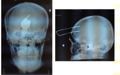 Đuổi bắt trộm chó bị bắn chĩa gim giữa trán