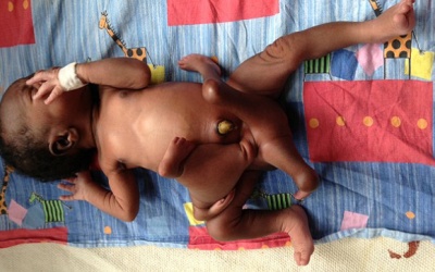 Phẫu thuật cắt bỏ 4 chi thừa cho cậu bé 3 tháng tuổi