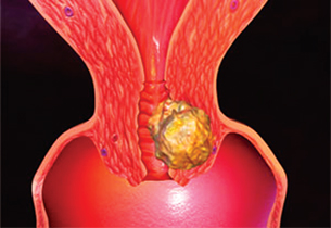 7 phụ nữ Việt chết vì ung thư cổ tử cung mỗi ngày