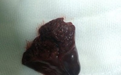 Phẫu thuật thành công ca vỡ lách giãn đồng tử