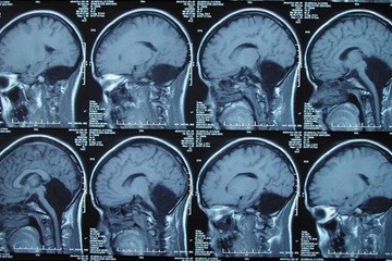 Sống bình thường hơn 20 năm dù không có tiểu não