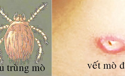 Sốt mò: Có thể tử vong nếu không phát hiện kịp thời