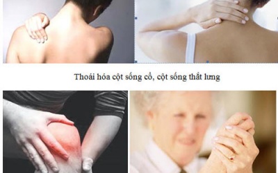 Đau nhức xương khớp - Bệnh thường gặp của người già