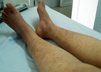 Nhập viện do uống thuốc của thầy lang