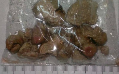 Gắp viên sỏi kích thước lớn trong thận bệnh nhân