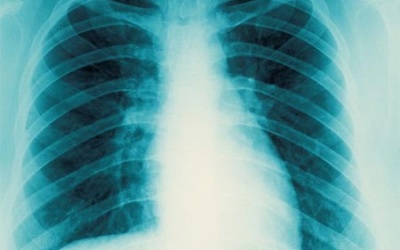 Kinh ngạc con người có khả năng phục hồi xương sườn