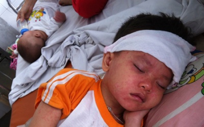 Những câu hỏi thường gặp về bệnh sởi